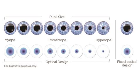 Lens Pupil Difference at Christina Peltier blog