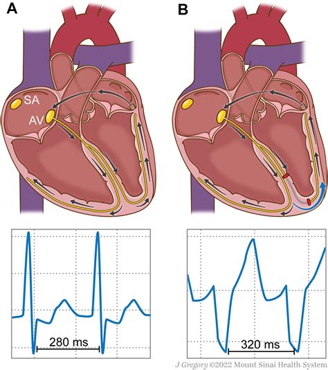 Wide Complex Tachycardia: The Answer Is in Front of You | JACC: Case Reports