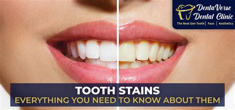 Image result for Tooth Stain