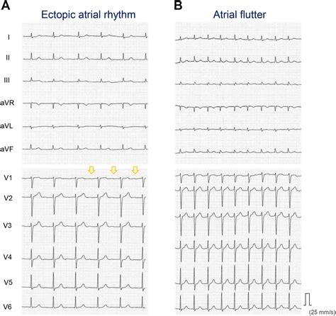 Subclinical persistent atrial fibrillation in left atrium behind the ectopic atrial rhythm on ...