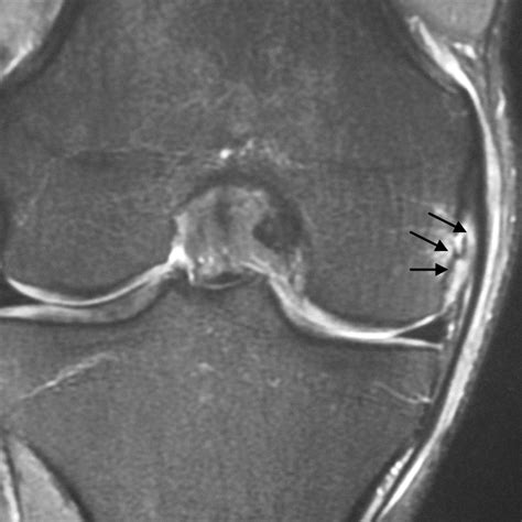 Injury to the proximal deep medial collateral ligament | Bone & Joint