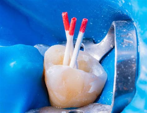 How Long Does an Emergency Root Canal Take?