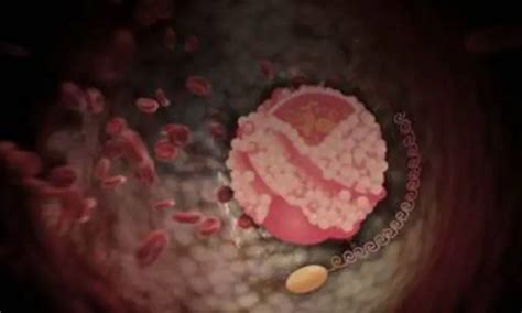 Single dose of lepodisiran reduces lipoprotein A more than 94 percent ...