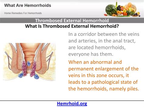 Thrombosed External Hemorrhoid | PPTX