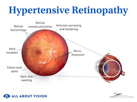Retinopathy How Does It Affect Vision
