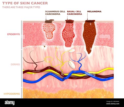 Skin tumors, moles and spots, 3d section of the skin layer. Three types of skin cancer, squamous ...