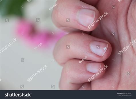 Zinc Deficiency Ridged Fingernails at Constance Woodford blog