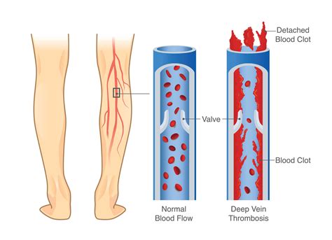 Arterial Thrombosis Vs Venous Thrombosis