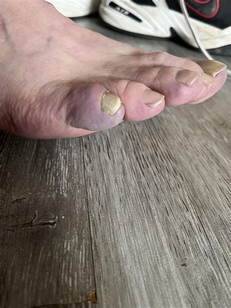 FIL (60m) pinky toes (both feet) look like this. He says they’re very ...