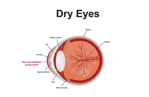 What Causes Dry Eyes with Contacts?