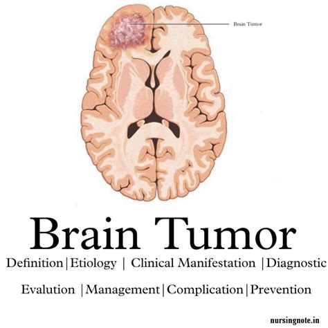 Brain Tumor - 2nd Year GNM Medical Surgical Nursing II, Oncology ...