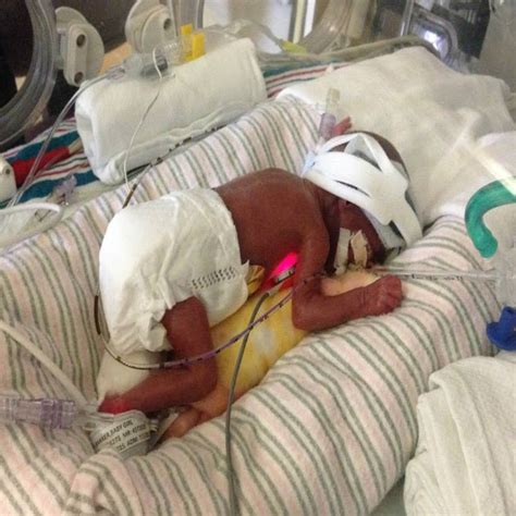 Miracle baby, born premature at 25 weeks, is beating the odds - Baby AZ ...