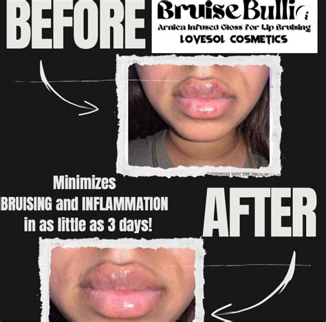 Bruise Bullie-Arnica Infused Lip Gloss for Post Lip Augmentation Care ...