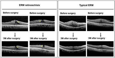 Comparisons of Clinical Characteristics and Surgical Outcomes of Epiretinal Membrane ...