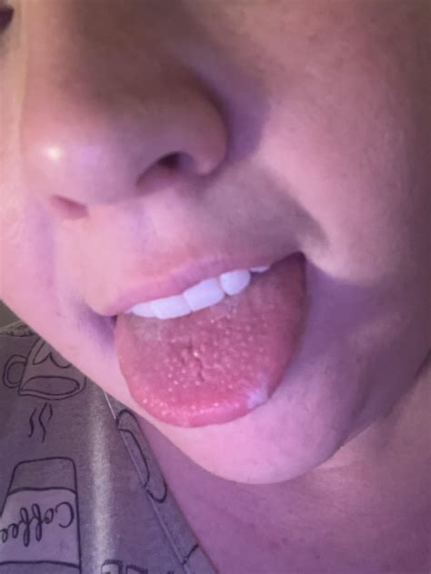 Canker sore and inflamed taste buds? : r/CankerSores