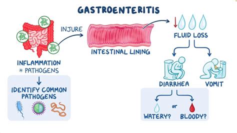 Gastroenteritis: Understanding the Stomach Bug