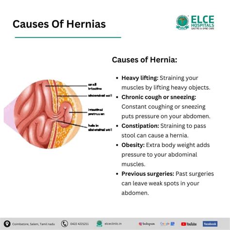 Hernia Treatment in Coimbatore at Elce Clinic - Elce Clinics