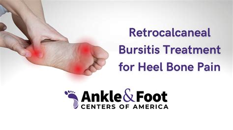 Understanding and Treating Retrocalcaneal Bursitis