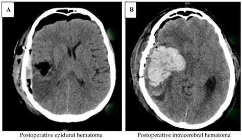 Impact of Perioperative Acetylsalicylic Acid (ASA) Administration on ...