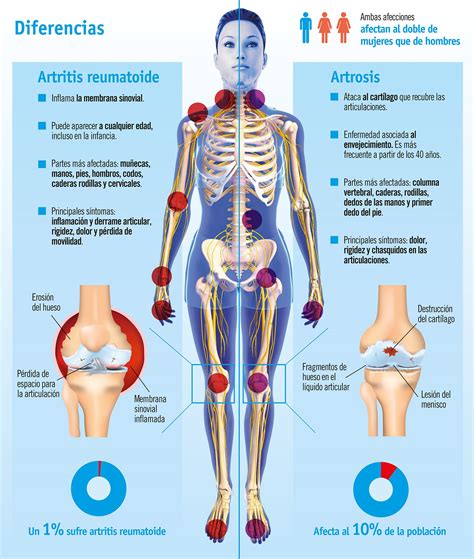 ¿Cuál es la diferencia entre Artritis y Artrosis? Causas y síntomas