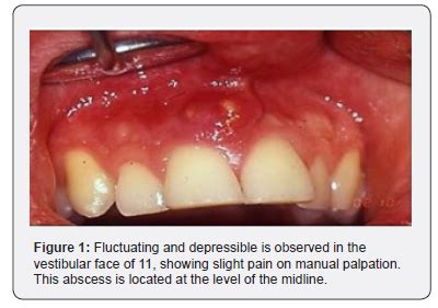 Bildergebnis für ruptured abscess in mouth