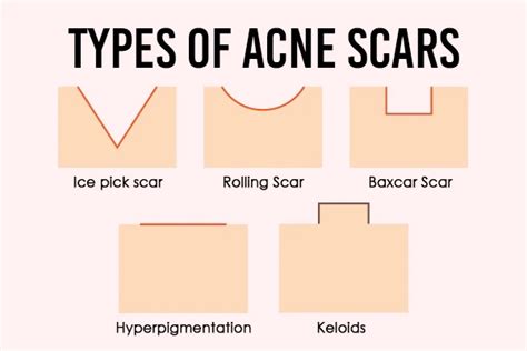 Get Rid of Acne Scars: Here’s How