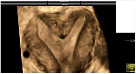 Prevalence of Septate Uterus in a Large Population of Women of Reproductive Age: Comparison of ...