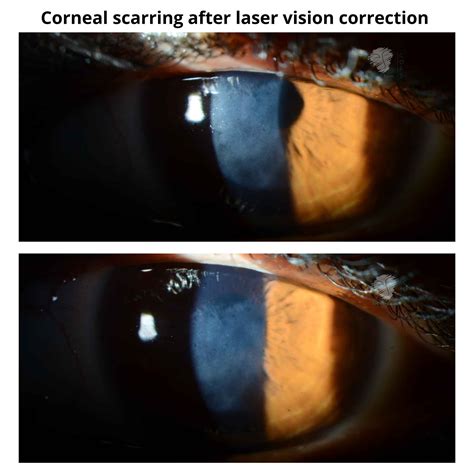Corneal scarring after laser vision correction - Dr Anthony Maloof
