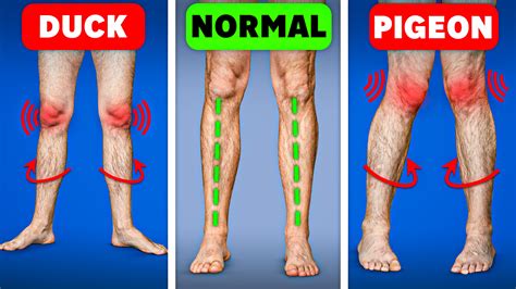Duck Footed: Causes, Signs & Care