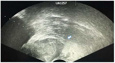 Current Approach to Complications and Difficulties during Transrectal ...
