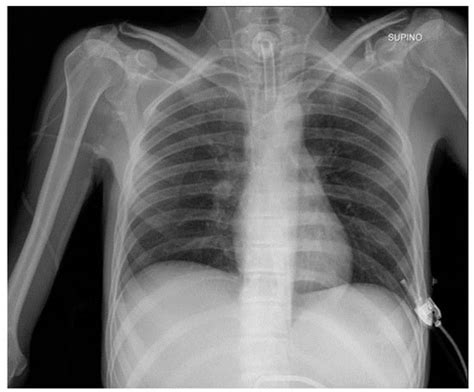 Chest X-ray Interpretation: Detecting Devices and Device-Related ...