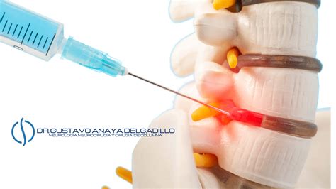 BLOQUEOS DE CIATICA – Grupo Neurológico CAJAL