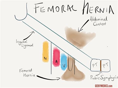 Inguinal and Femoral Hernias | Inguinal Canal Anatomy | Geeky Medics