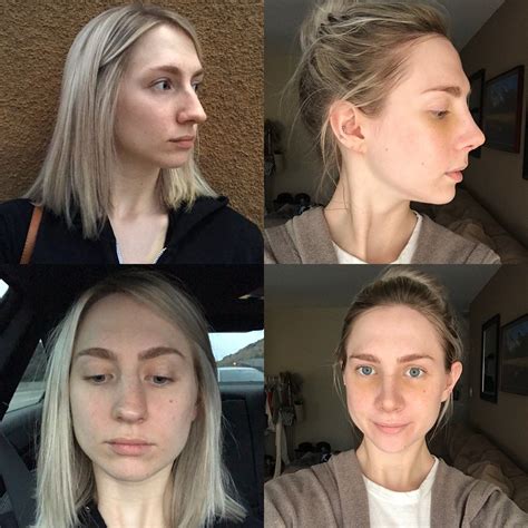 Nose Job Surgery, Recovery, Cast Removal & Two Week Post
