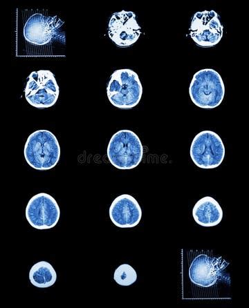 Image result for Normal Brain CT Scan