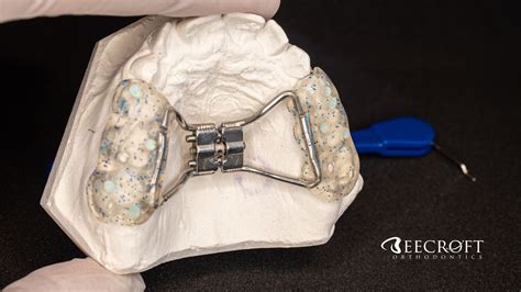 How Orthodontic Expanders Work | Beecroft Orthodontics — Top Orthodontist in Fredericksburg ...