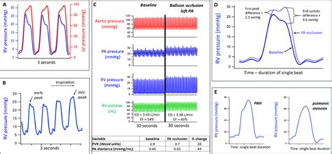 Right Ventricular Pressure Waveform Analysis—Clinical Relevance and ...