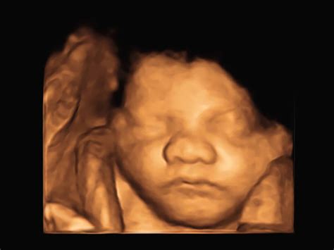 Down Syndrome Baby Ultrasound 2D/3D/4D Ultrasound Of The Fetal Face In