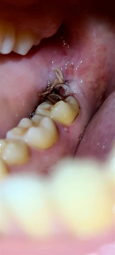 Is this normal after 5 days of wisdom teeth removal. Alot of the blood clot came loose by its ...