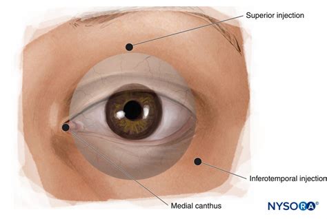Local Anesthesia Blocks 的图像结果