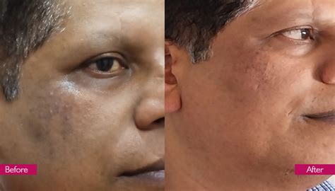 Best Skin Specialist for Pimple in Nashik – Sparsh Skin Clinic | Acne ...