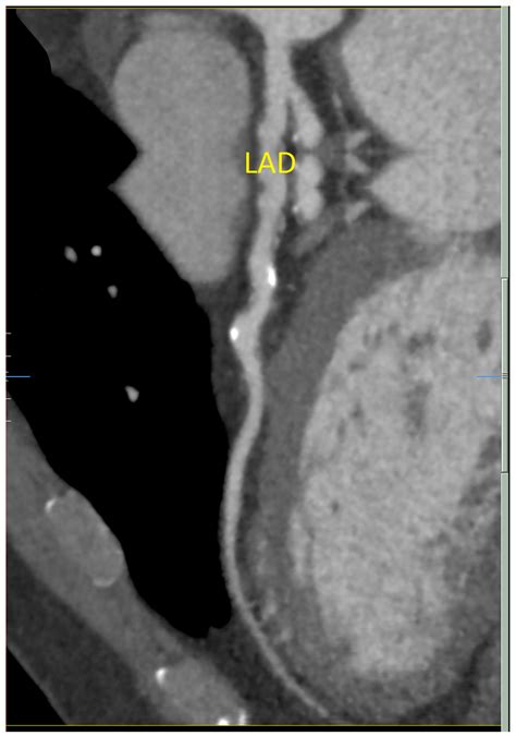 ST-Elevation Myocardial Infarction in Coronary Ectasia: A Case Report