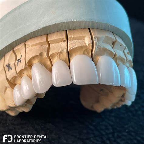 Frontier Dental Laboratories on LinkedIn: #dentallab #dental #dentist # ...