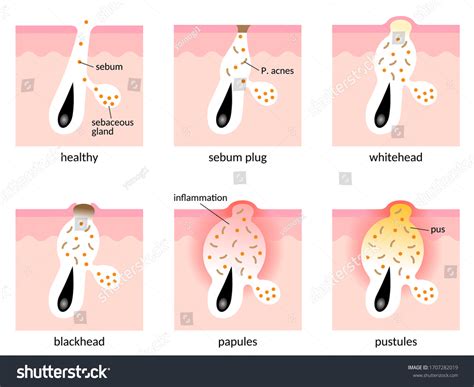 Image result for Sebum Plug Extraction