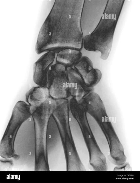 Normal wrist X-ray Stock Photo - Alamy