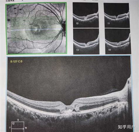 近视眼激光手术 - 近视的治疗,近视原因,近视手术后遗症介绍,近视眼恢复