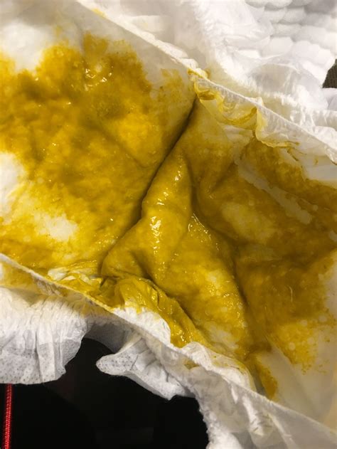 Berapa Lama Pesakit Cirit Birit Perlu Ditahan di Wad?