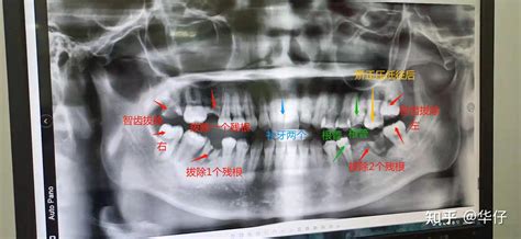 龙陵拔牙团购网站在哪_龙陵牙科