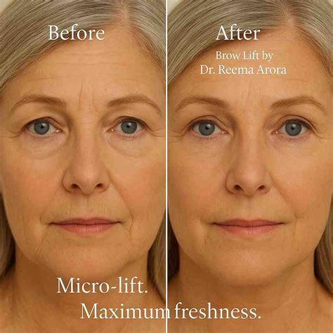 Eyebrow Lift in Delhi (2026) | Non-Surgical Cost, Results & Natural ...