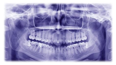 FAQ: Do I need my wisdom teeth out? | SpaDental Group